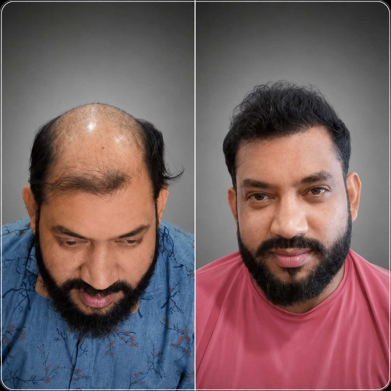 Grade 6 | 4520 Grafts | DHT Method - After 8 Months